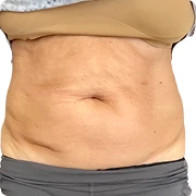 Before treatment image of K.Z.