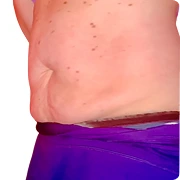 After treatment image of Lindsey H.