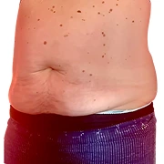 Before treatment image of Lindsey H.