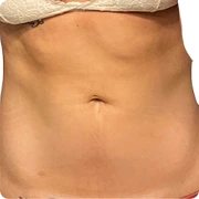 After treatment image of LoveLove L