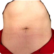 Before treatment image of LoveLove L