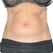 After treatment image of T.Lopez