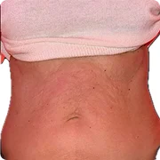 After treatment image of Tasha H.